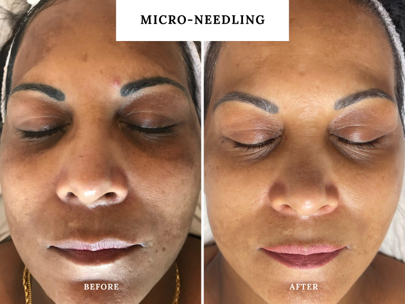 Microneedling