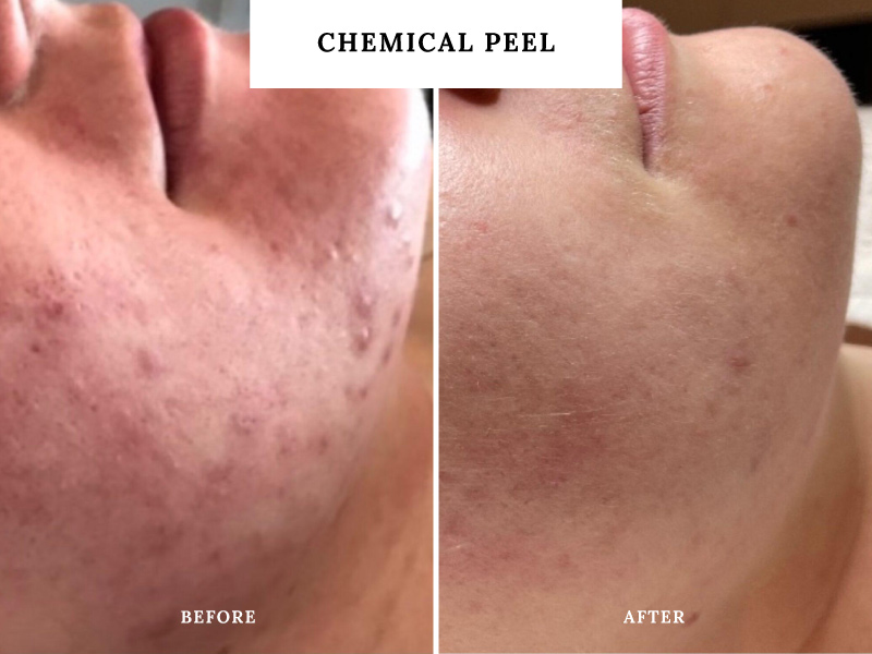 chemical-peel-teddington