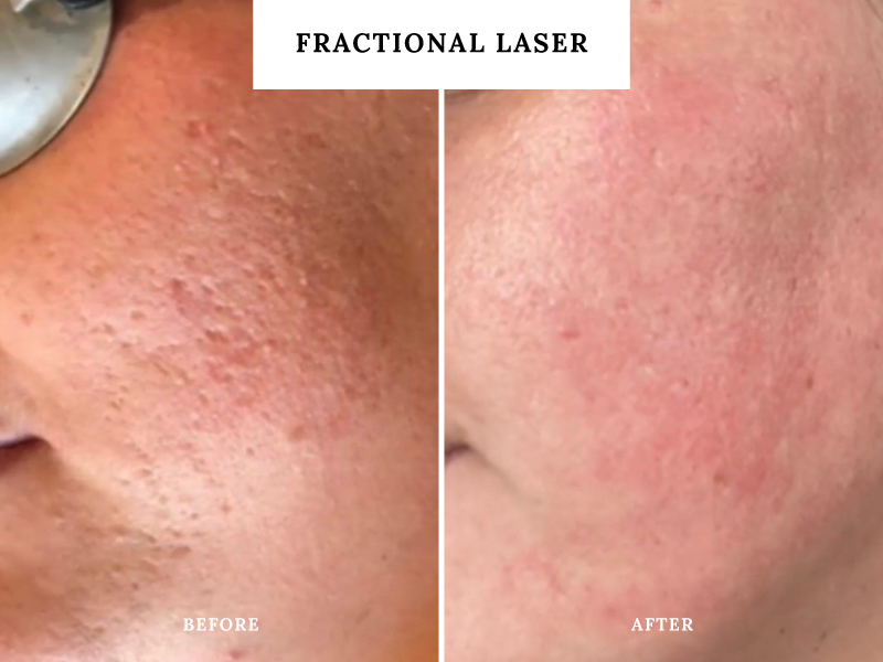 fractional-laser-teddington
