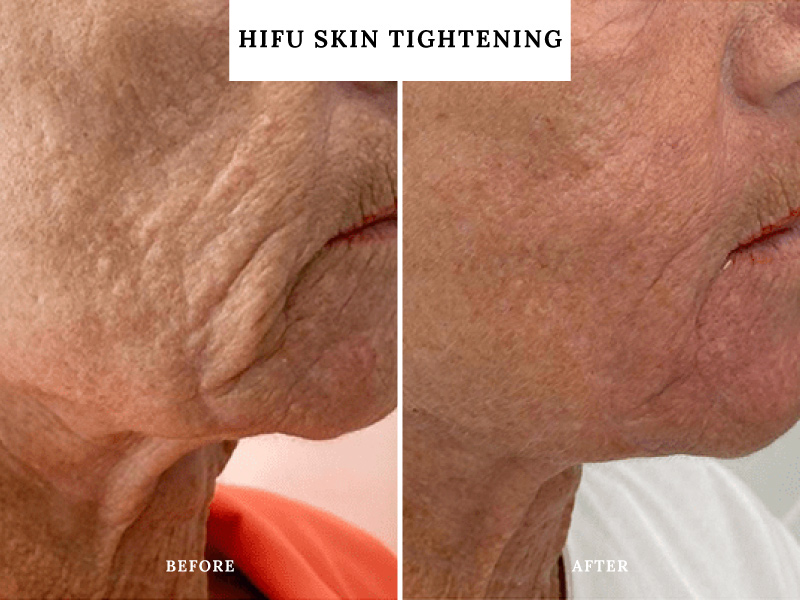 hifu-skin-tightening-teddington