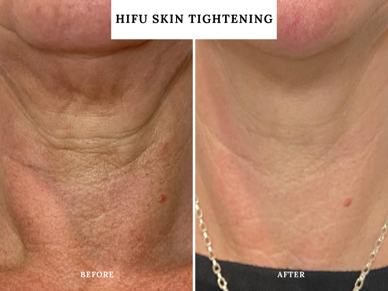 hifu-skin-tightening