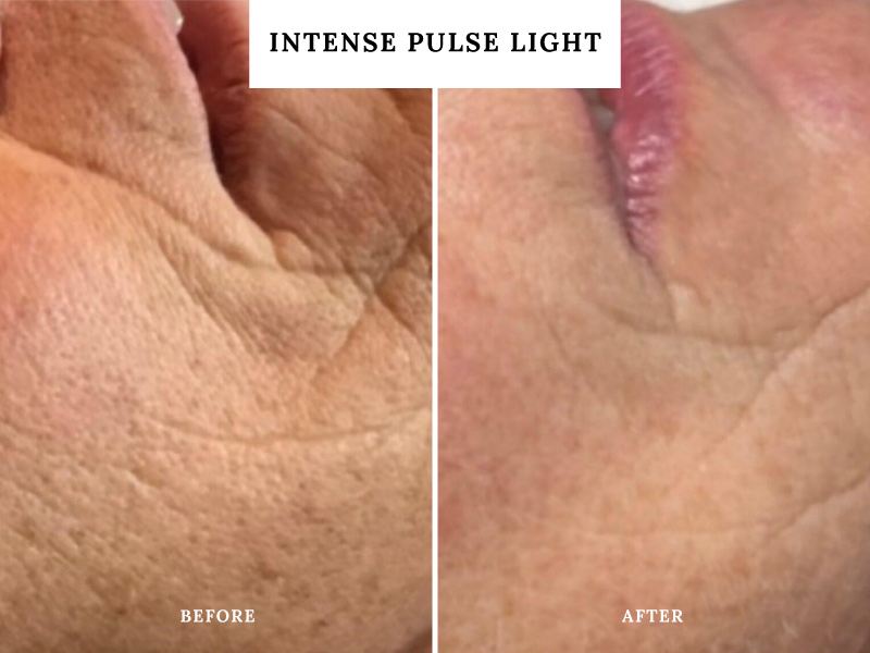 intense-pulse-light-teddington