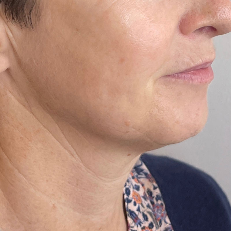 results after hifu skin tightening treatment in Teddington