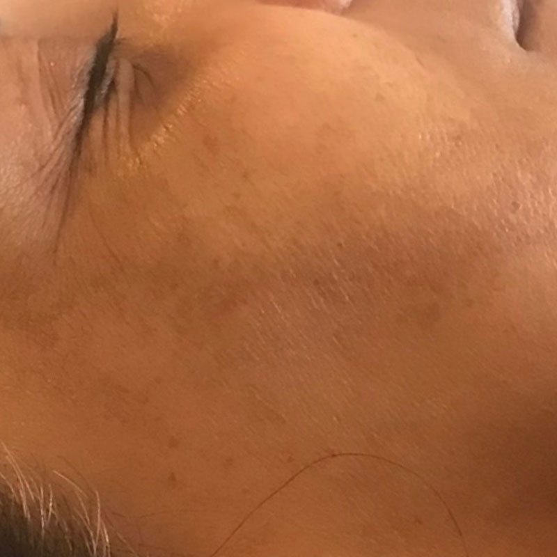 results after 4 sessions of microneedling treatment in Teddington