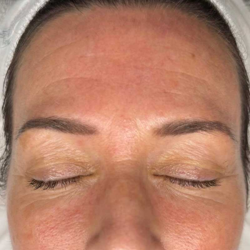 results before radiofrequency microneedling in Teddington