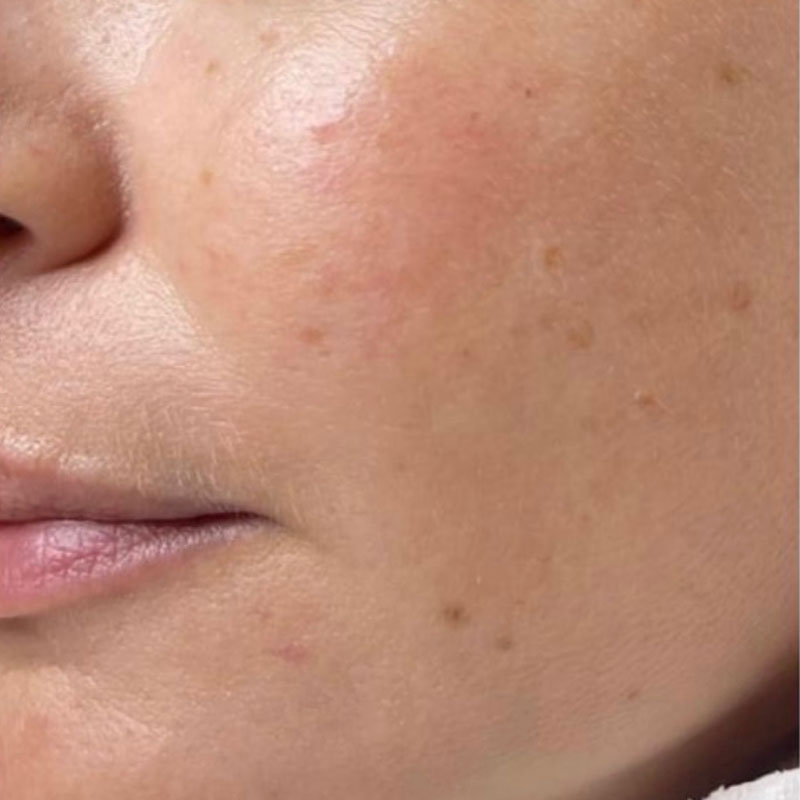 results after microneedling treatment in Teddington