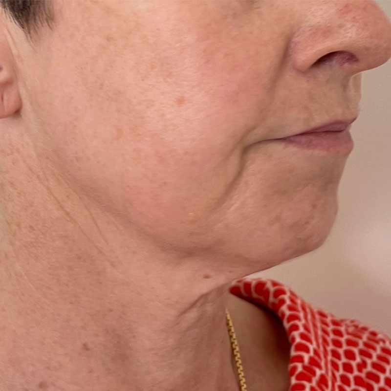 before hifu skin tightening treatment in Teddington