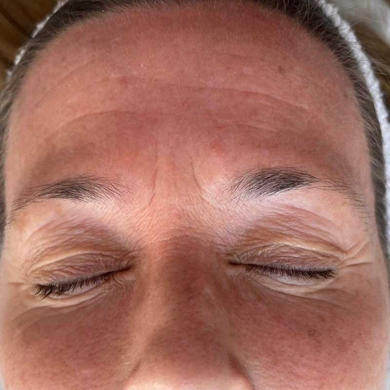 results before radiofrequency microneedling in Teddington