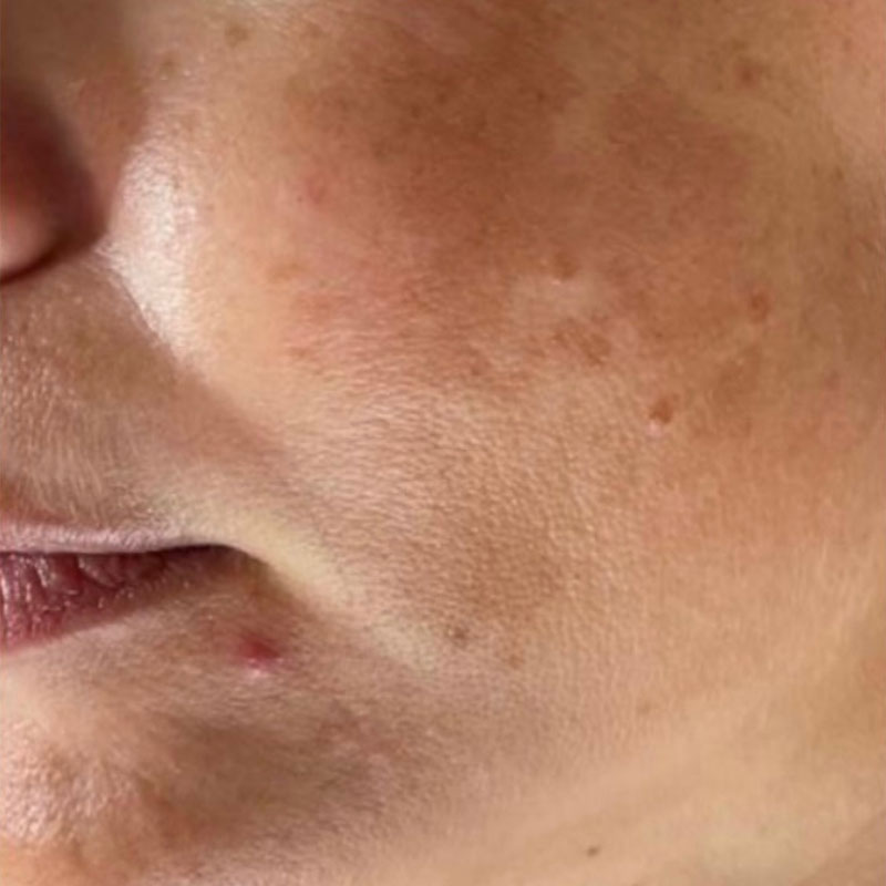 before microneedling treatment in Teddington