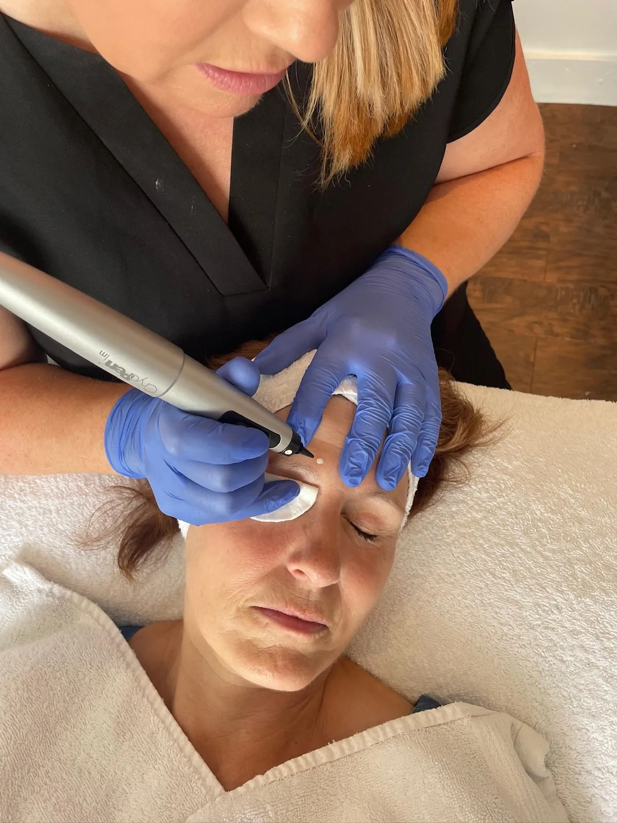 CryoPen treatment Teddington