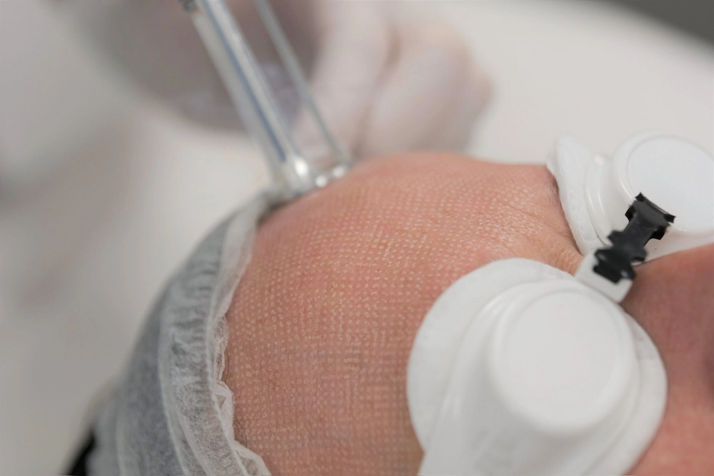 fractional laser resurfacing in Teddington