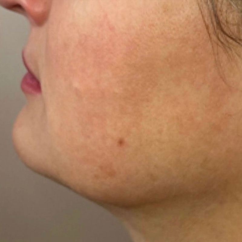 Results after HIFU skin tightening Teddington