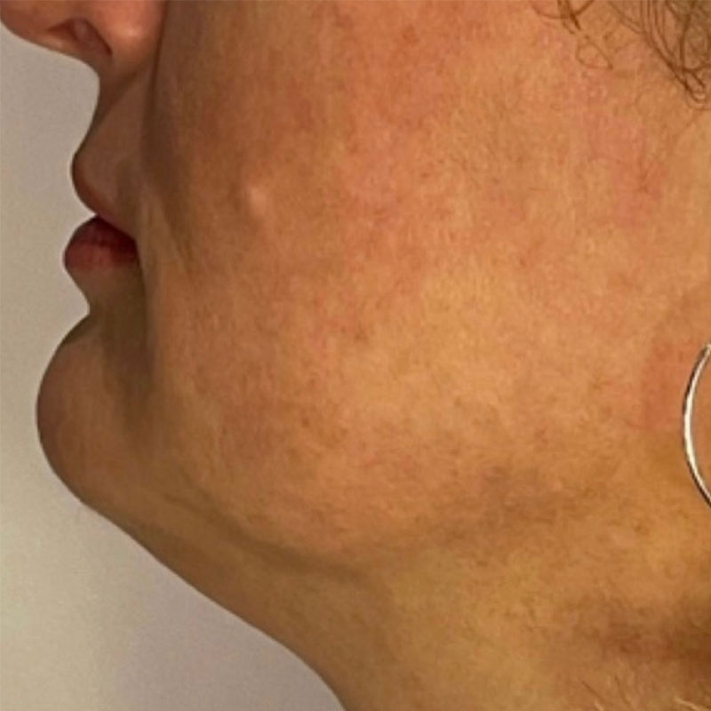 HIFU skin tightening Teddington