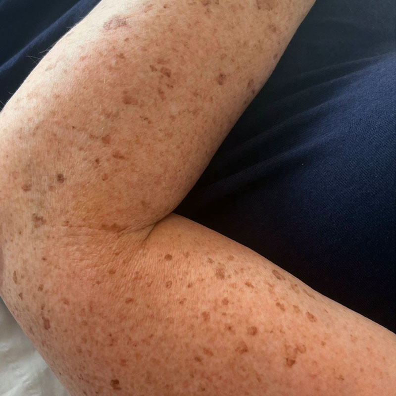 ipl-freckle-reduction-teddington-skin-results-after Results after IPL treatment for freckle and pigmentation reduction, Teddington