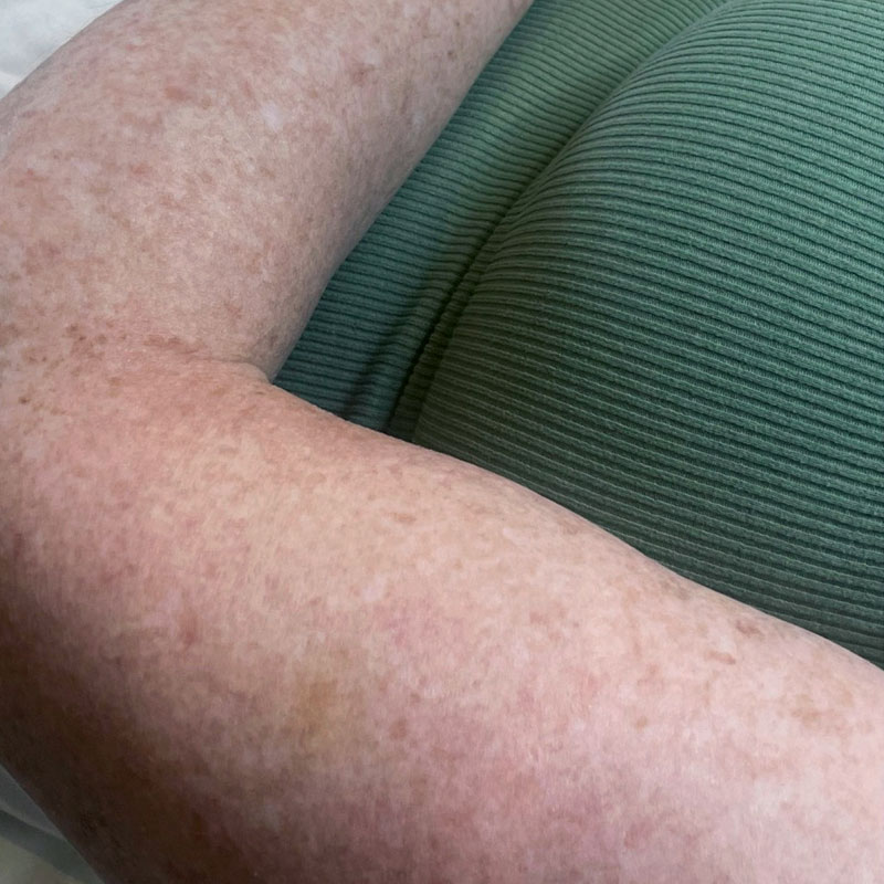 ipl-freckle-reduction-teddington-skin-results-before Results before IPL treatment for freckle and pigmentation reduction, Teddington