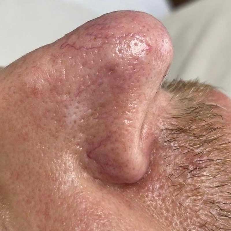 ipl-treatment-teddington-facial-veins-after Skin appears clearer after IPL treatment with reduced redness and veins