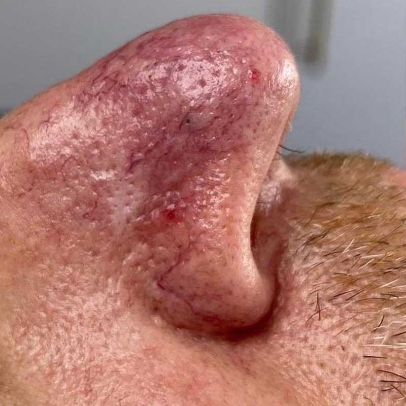 ipl-treatment-teddington-facial-veins-before Skin with visible redness and thread veins before IPL treatment