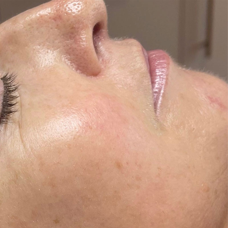 ipl-treatment-teddington-skin-results-after Skin appears clearer after IPL treatment with reduced redness
