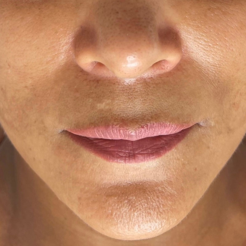 Results after microneedling treatment in Teddington