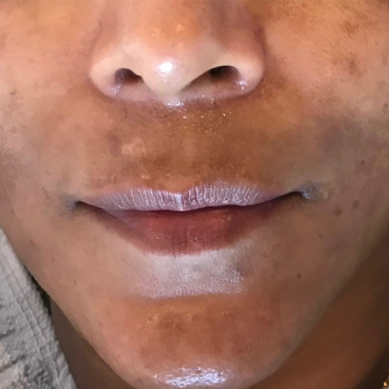 Microneedling treatment in Teddington