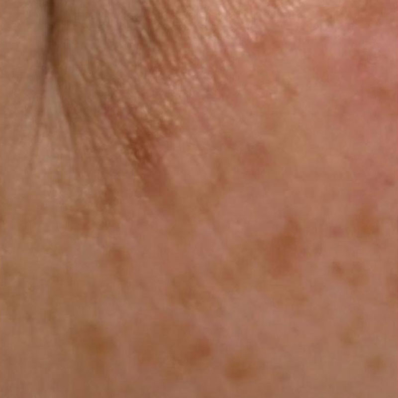 pigmentation removal teddington - results after CryoPen treatment