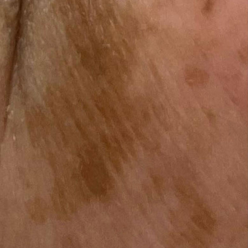 pigmentation removal teddington - cryopen 