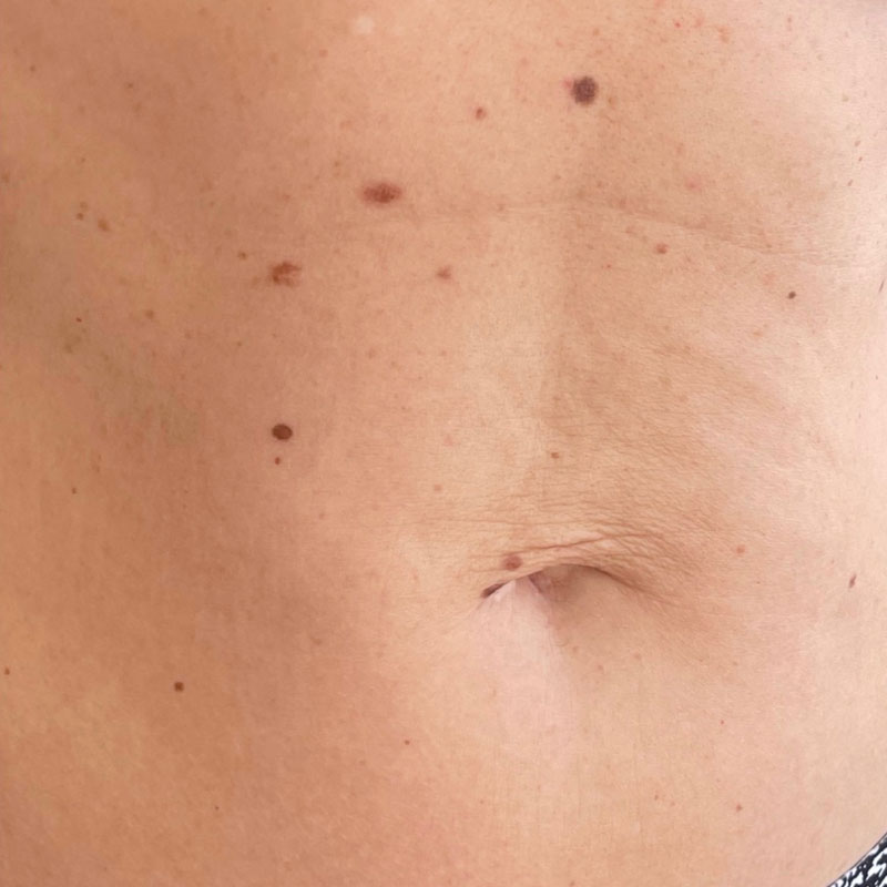 results after radiofrequency microneedling treatment in Teddington. Skin appears firmer