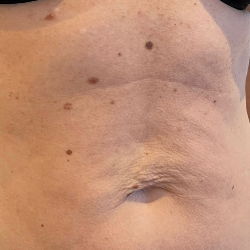 results before radiofrequency microneedling treatment in Teddington
