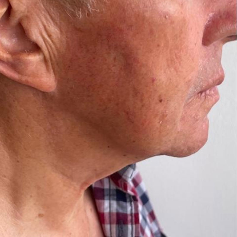 results after hifu treatment in Teddington