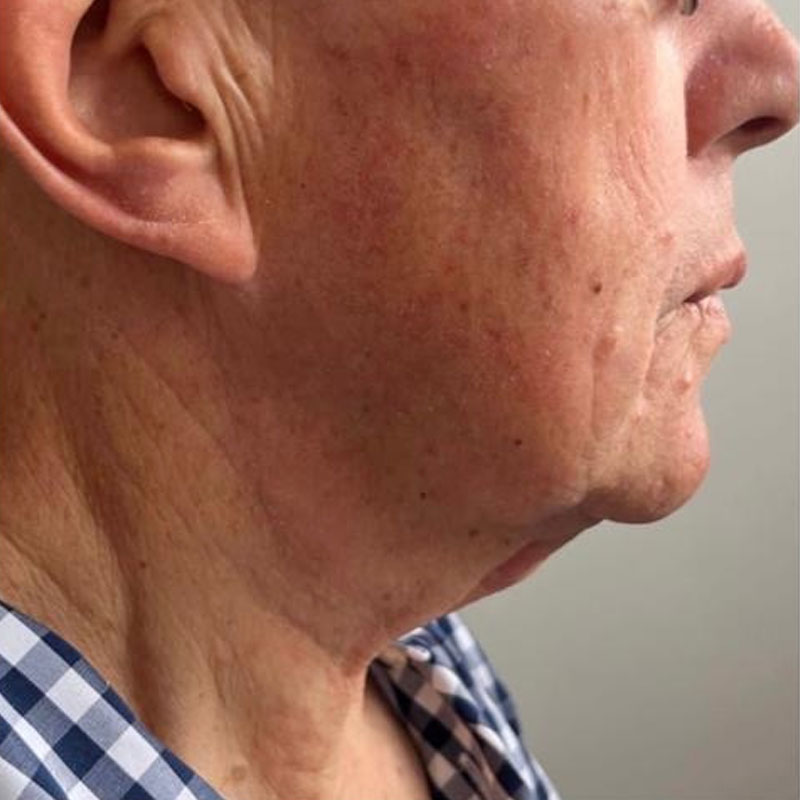 results before hifu treatment in Teddington