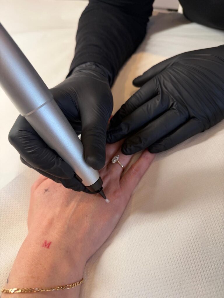 Skin tag removal treatment using CryoPen in Teddington clinic