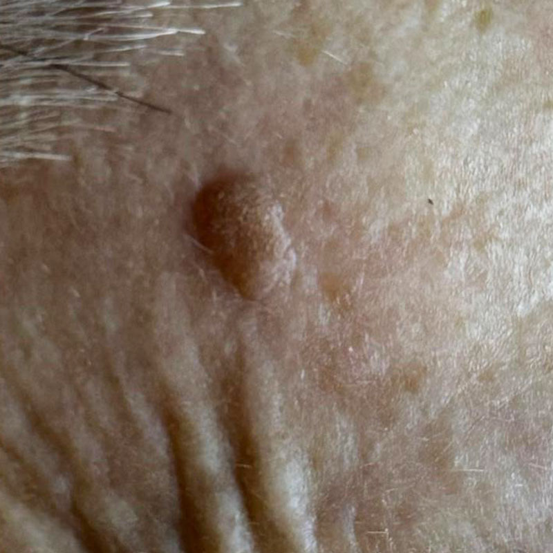 solar keratosis teddington