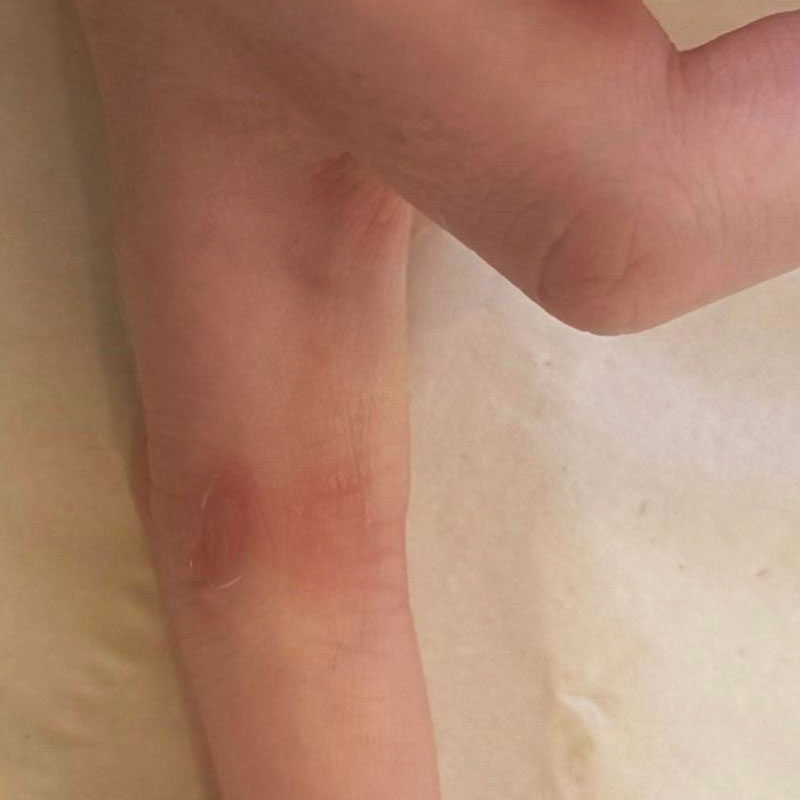 wart removal Teddington - results after 10 sessions