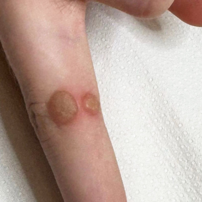 wart removal teddington